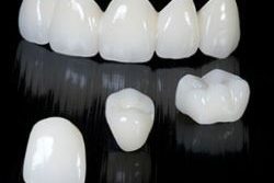 RĂNG SỨ EMAX